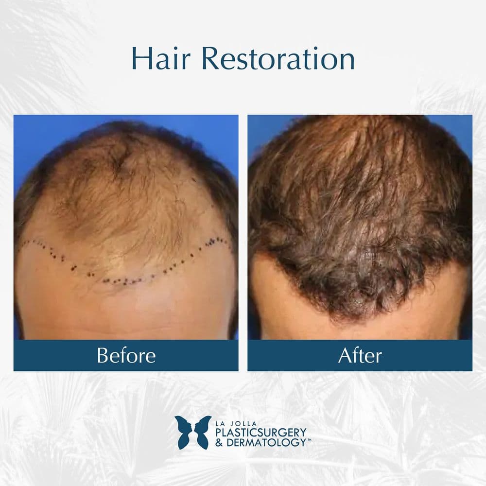 La Jolla Plastic Surgery & Dermatology - hair transplant in La Jolla, CA