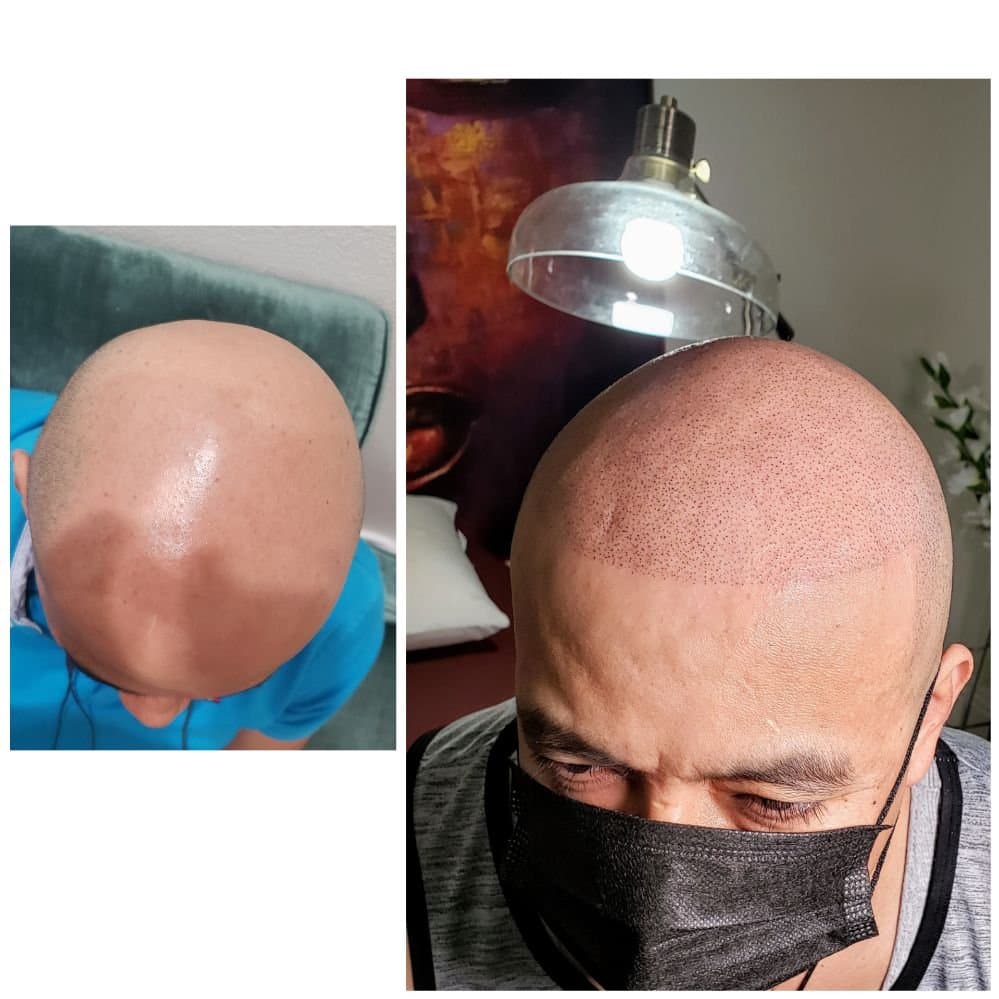 Hairline SMP - hair transplant in Las Vegas, NV