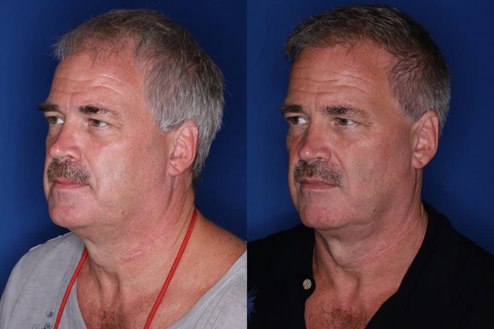 Kalos Hair Transplant - hair transplant in Atlanta, GA