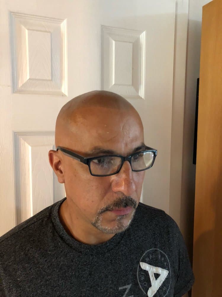 South Beach Scalp Micropigmentation Clinic - hair transplant in Miami Beach, FL