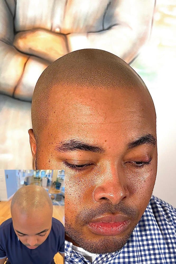 Scalp Micro - hair transplant in Grand Blanc, MI