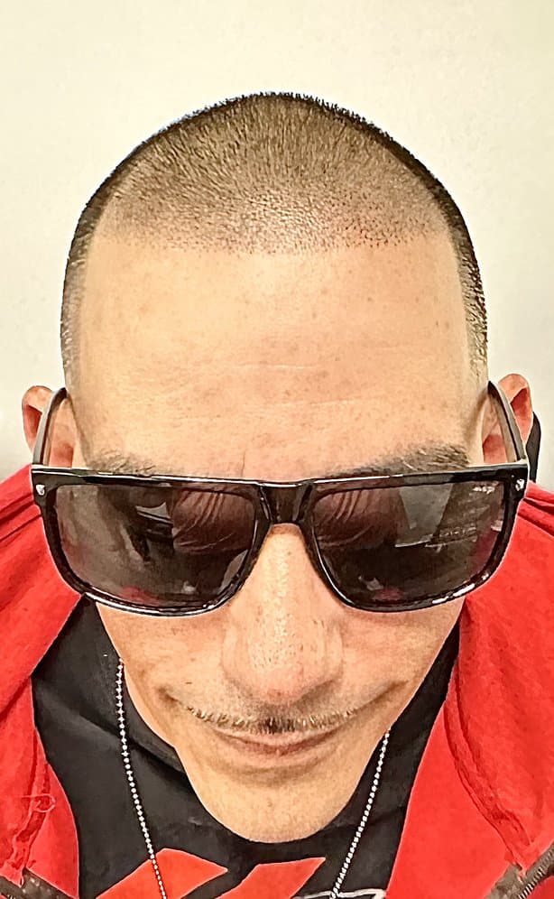 Think Ahead Scalp Micropigmentation - hair transplant in Union, NJ