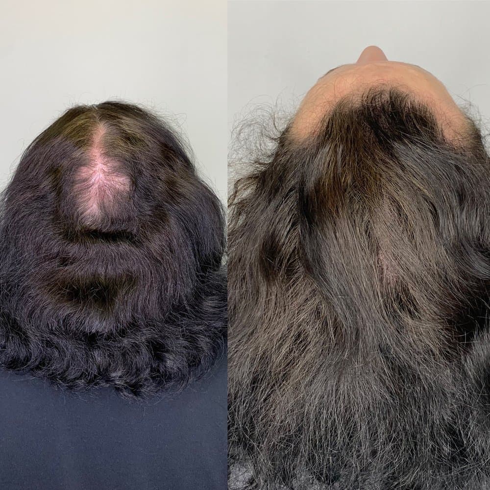 Scalp Headquarters - hair transplant in Kansas City, MO