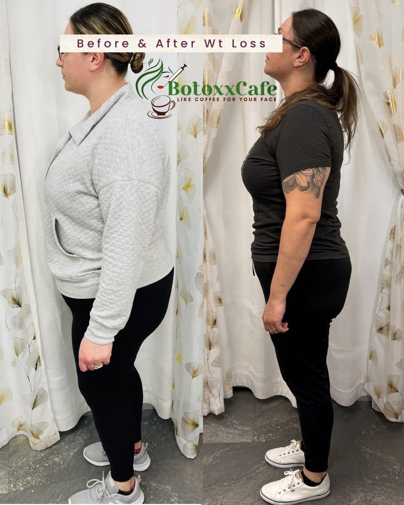 BotoxxCafe - hair transplant in Santa Clara, CA