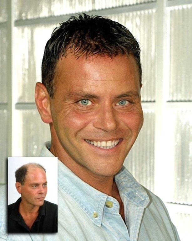 Apollo Hair Replacement - hair transplant in Dallas, TX