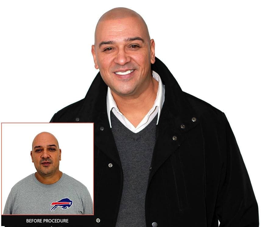 Scalp Aesthetics Pittsburgh - hair transplant in Wexford, PA