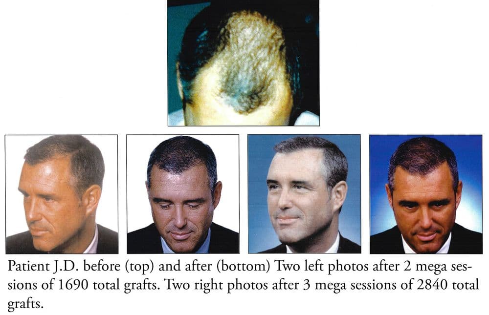 Pacific Hair Institute - hair transplant in San Francisco, CA