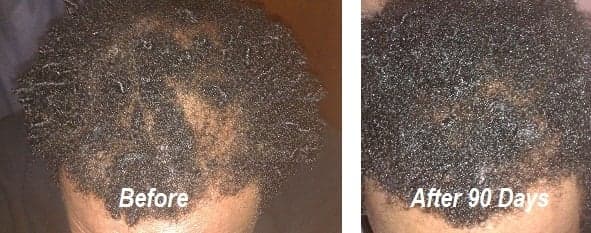 Hair Loss Control Clinic New Orleans - hair transplant in Metairie, LA