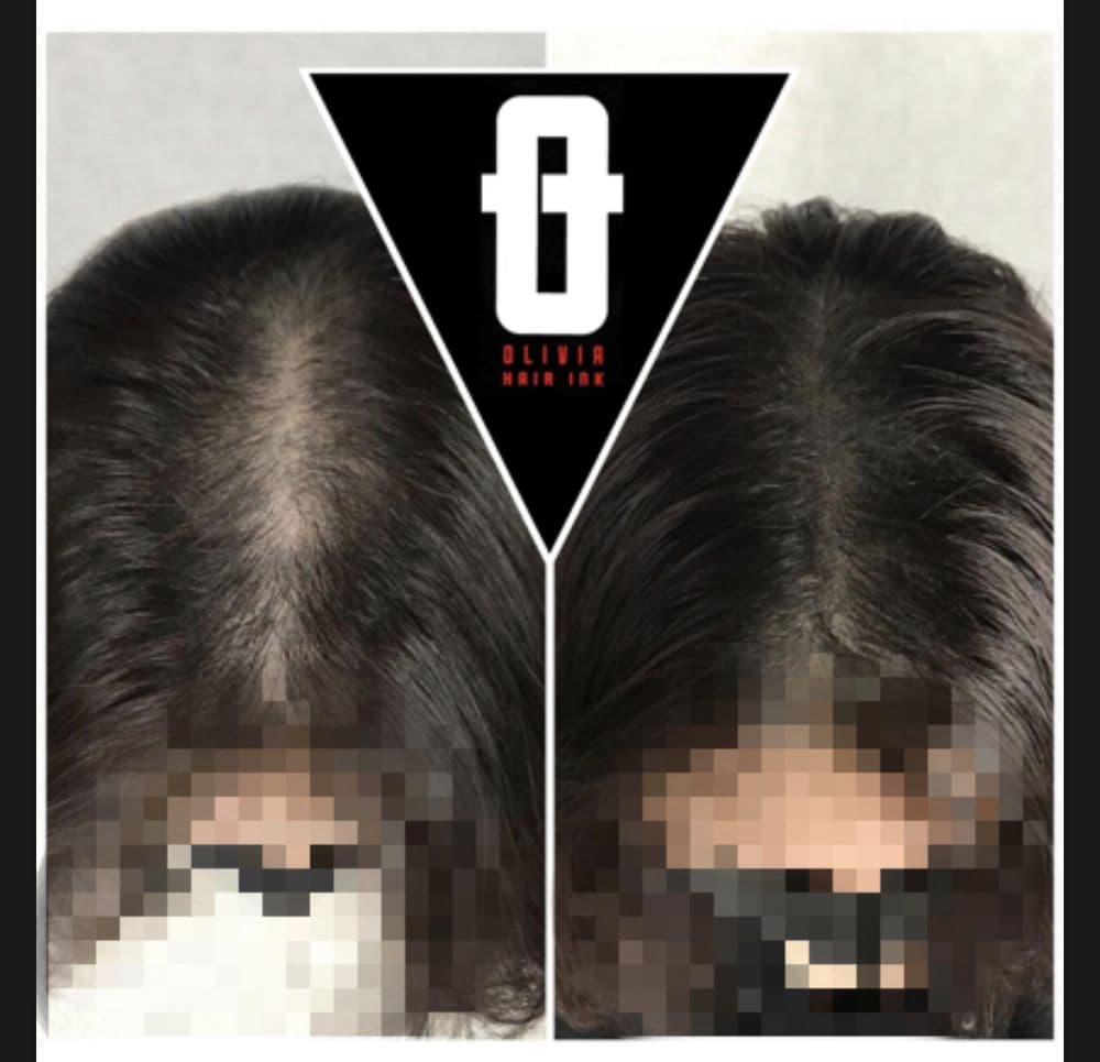 Olivia Hair Ink - hair transplant in Palo Alto, CA