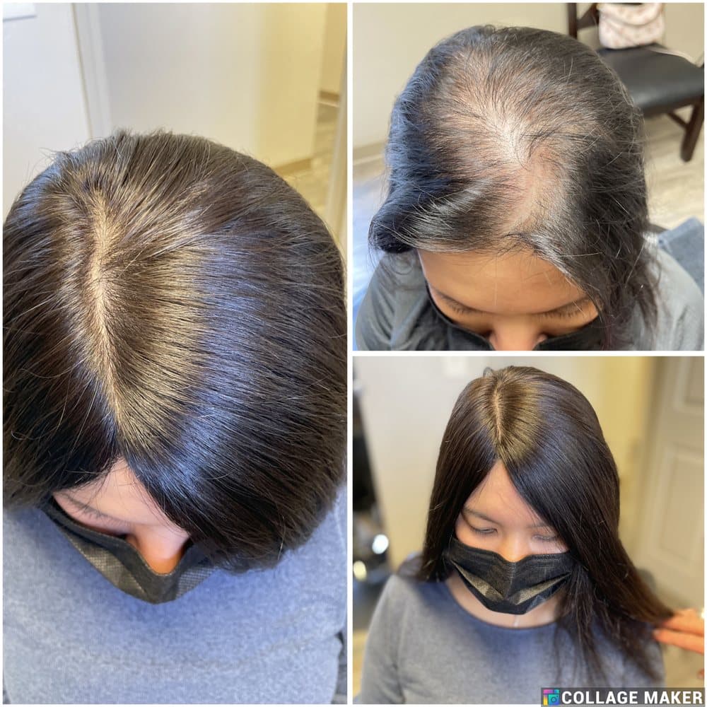 New Look Institute - hair transplant in San Jose, CA