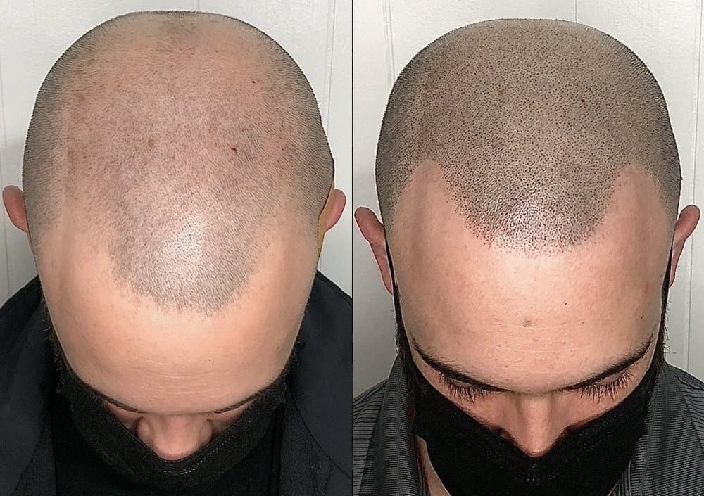 Oracle Scalp Micropigmentation - hair transplant in New Metairie, LA
