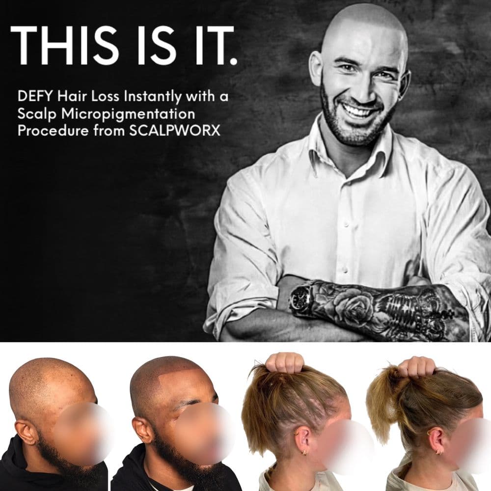 Scalpworx - hair transplant in Atlanta, GA