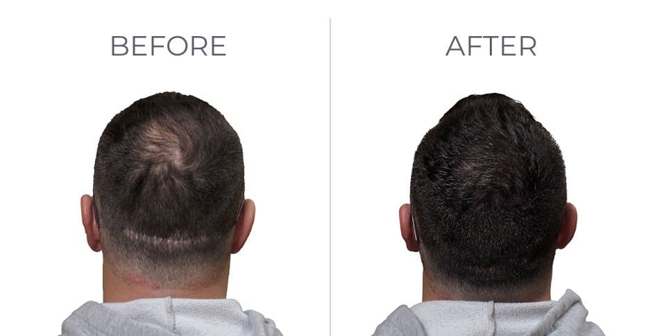 Mink - hair transplant in Albuquerque, NM