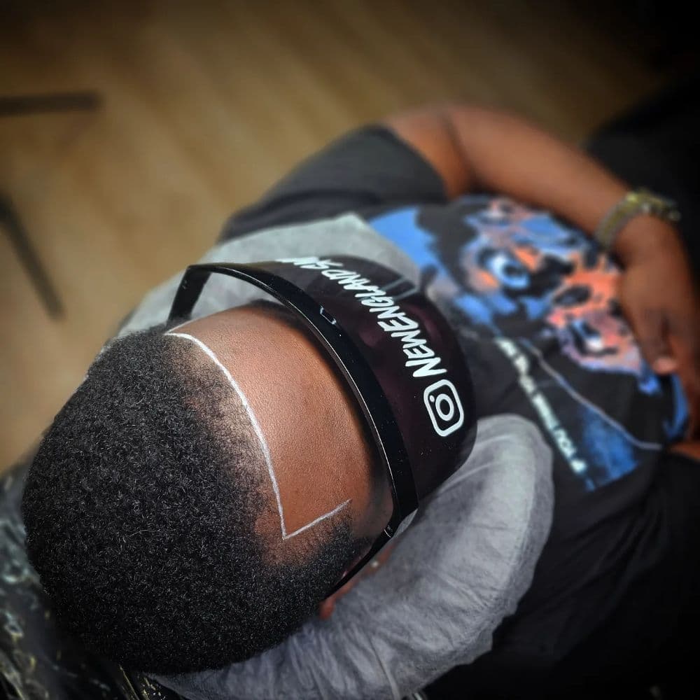 NewEngland.SMP - hair transplant in Providence, RI