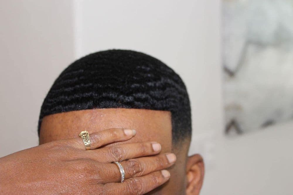 Chrissy B Cuttn - hair transplant in Los Angeles, CA
