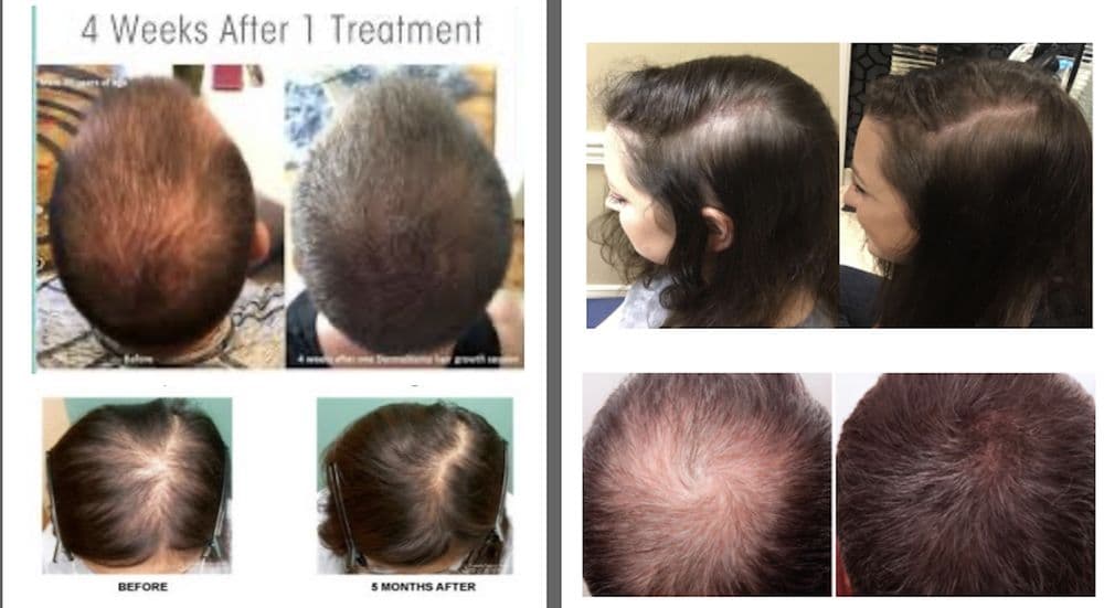 Needle Play Acupuncture - hair transplant in San Francisco, CA