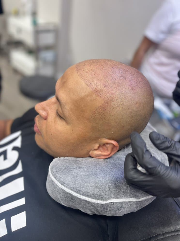 Devise SMP - hair transplant in Brownstown , MI