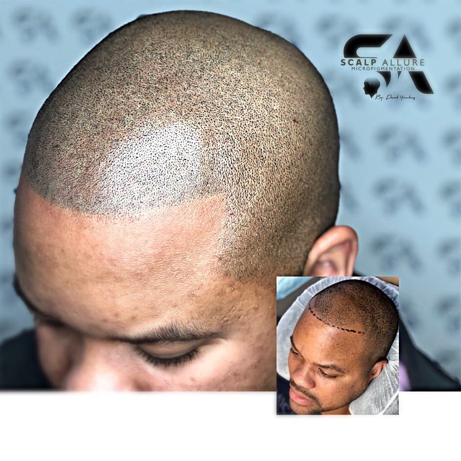 Scalp Allure - hair transplant in Bethesda, MD