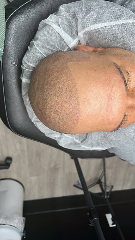 California Scalp Micropigmentation - hair transplant in Dixon, CA