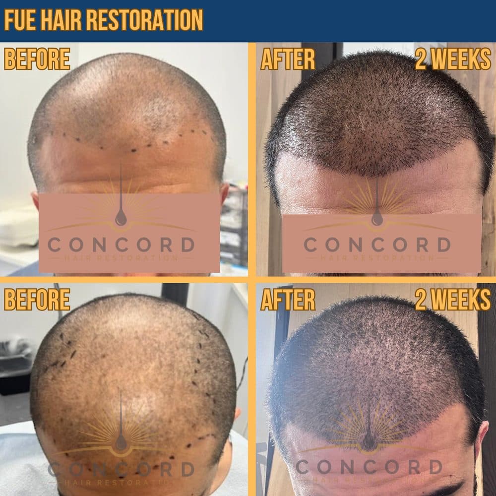 Concord Hair Restoration - hair transplant in San Diego, CA