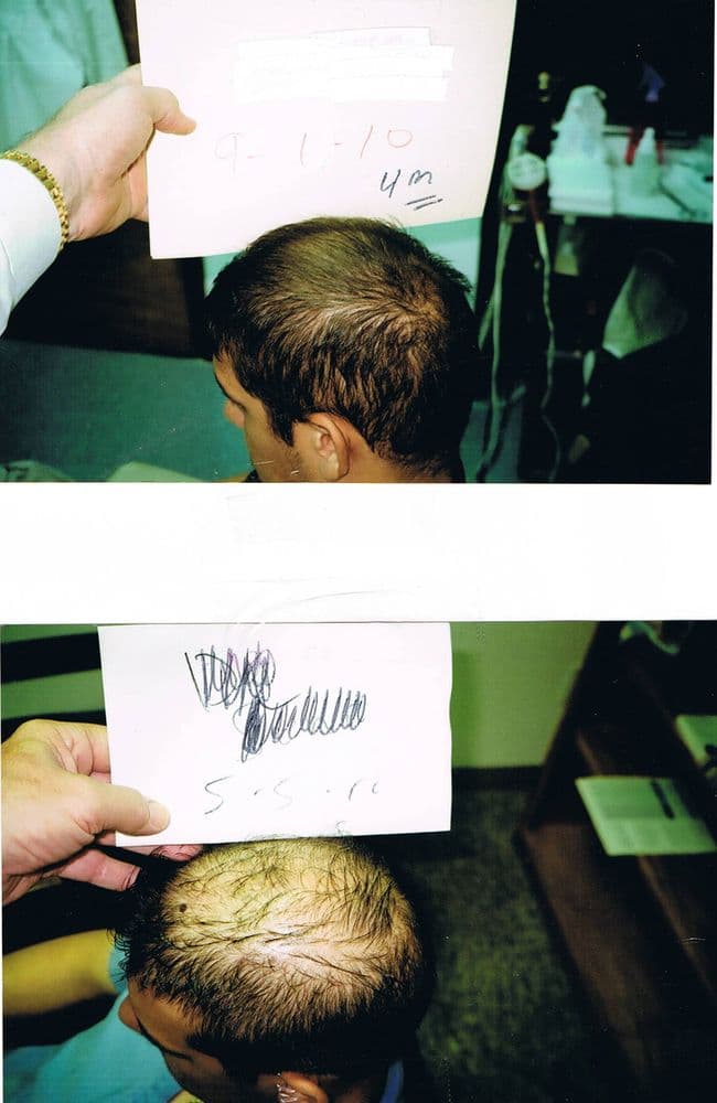 Tampa Bay Hair Restoration - hair transplant in Tampa Bay, FL