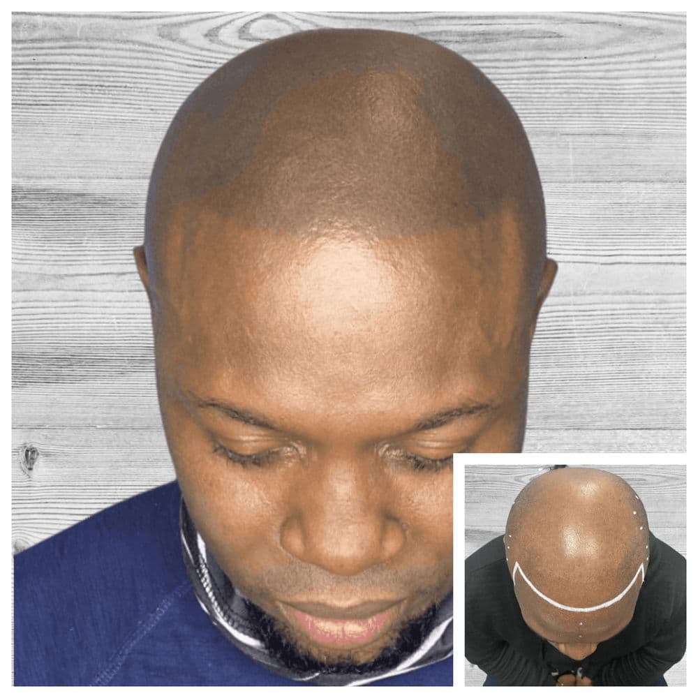 New Life Scalp - hair transplant in long island city, NY