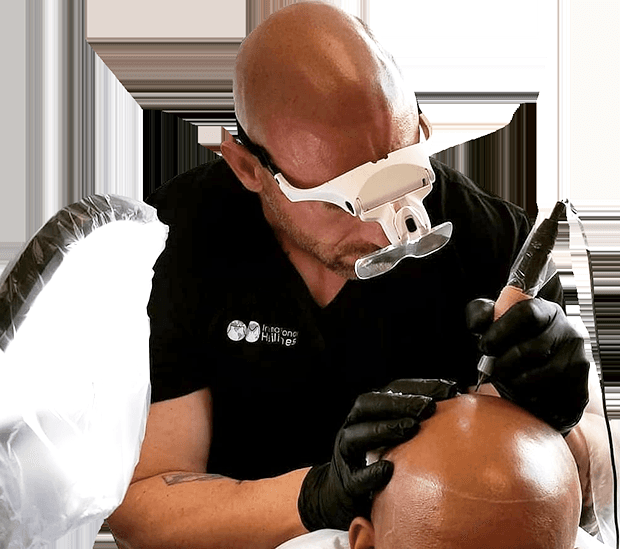 Scalp International Hairlines - hair transplant in Raleigh, NC