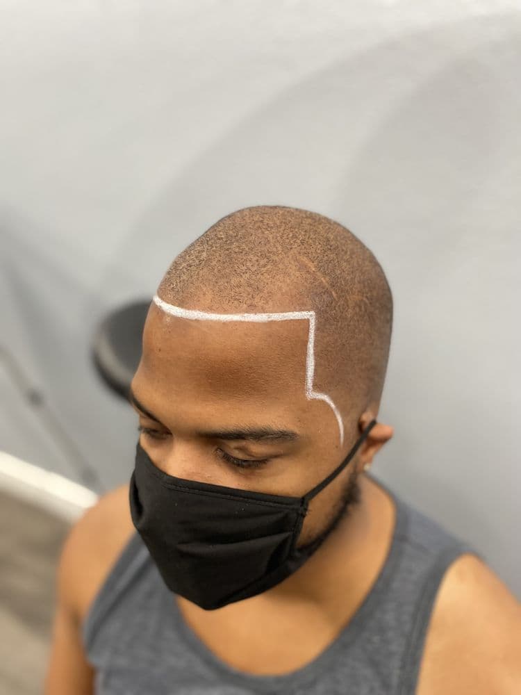Lunar Scalp Micro Pigmentation - hair transplant in Orlando, FL