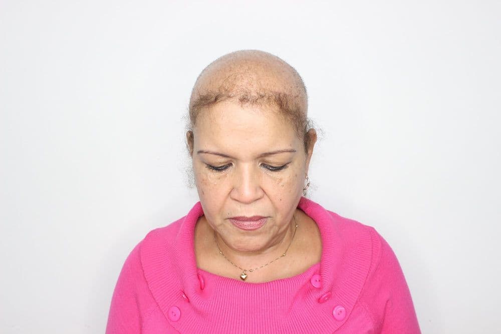 Total Secret By Carla Acosta - hair transplant in Hollywood, FL