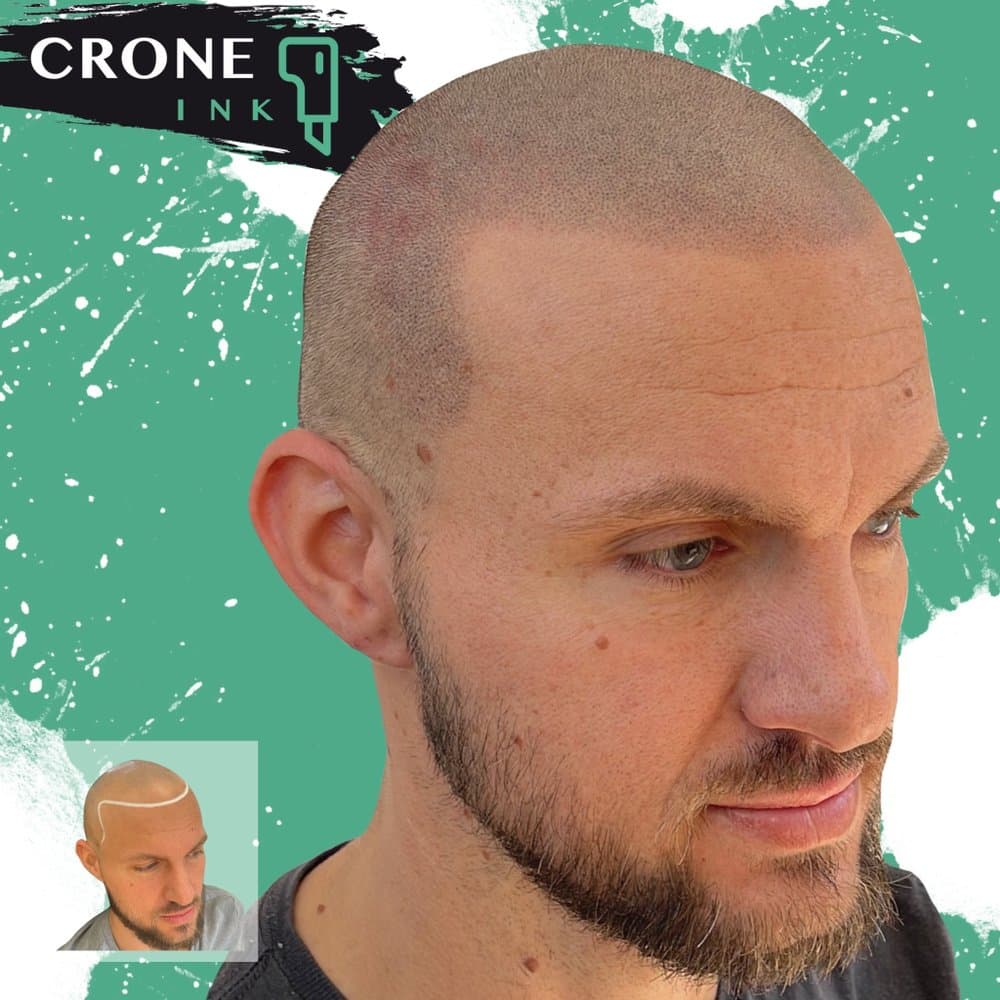 Crone Ink SMP - hair transplant in Indianapolis, IN