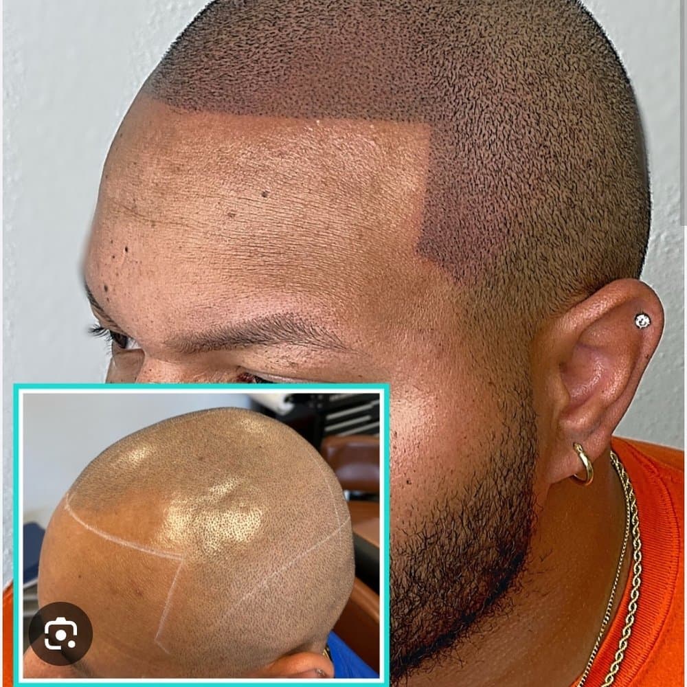 Inked Innovations - hair transplant in Austin, TX