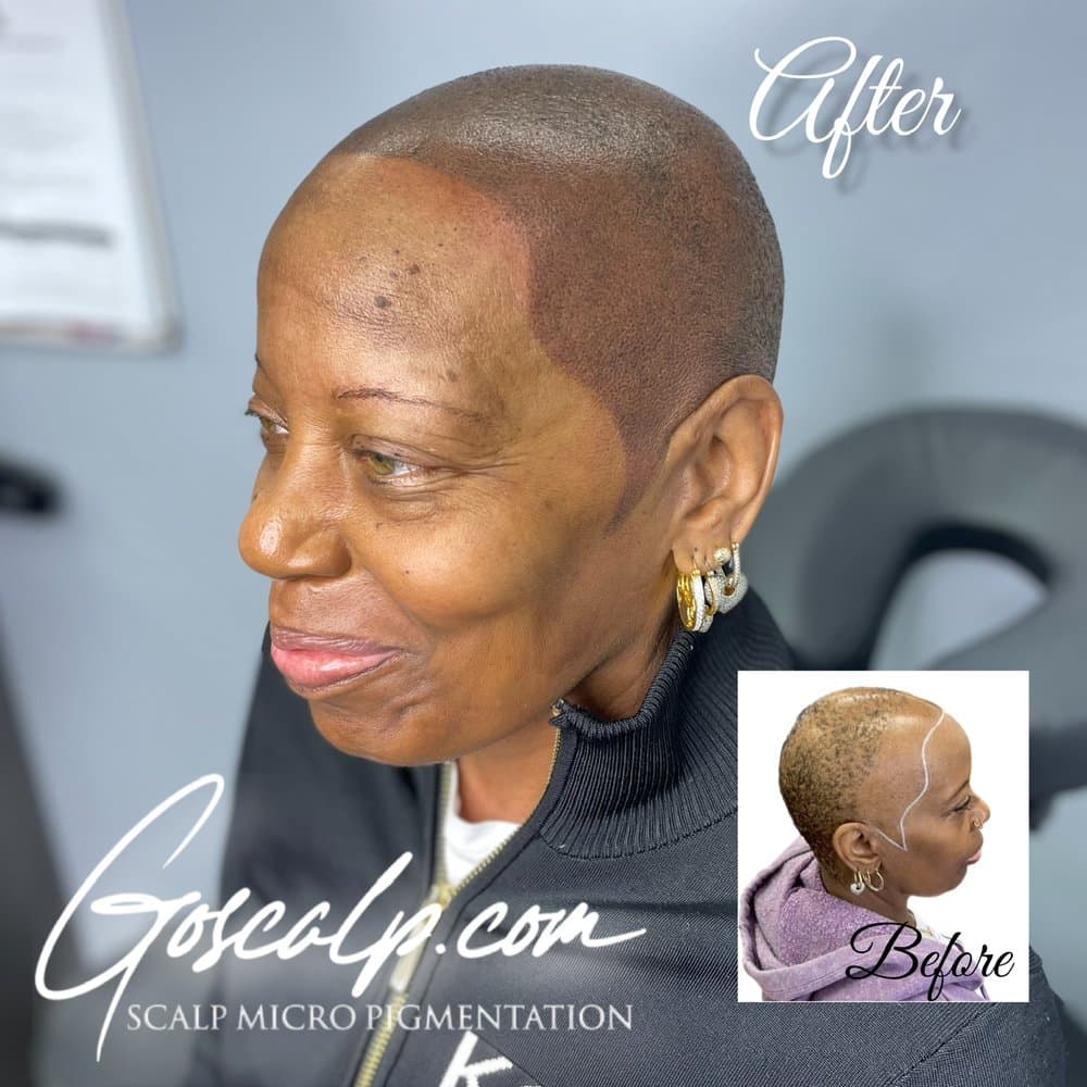 Goscalp Micropigmentation Clinic - hair transplant in Stonecrest, GA