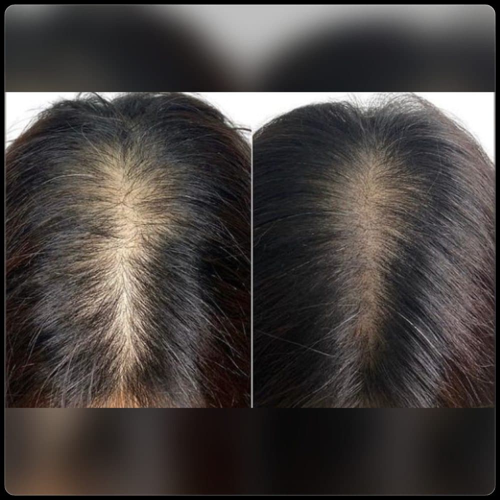 SMP San Diego - hair transplant in San Diego, CA