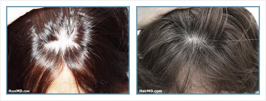 Herbert S Feinberg, MD - hair transplant in Englewood, NJ