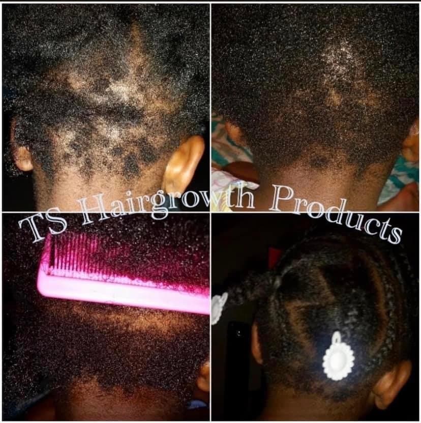 TS Hairgrowth Salon - hair transplant in Bartlett, TN