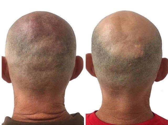 ScalpClub - hair transplant in San Diego, CA