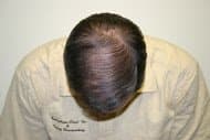 Dr. Roy B. Stoller - hair transplant in Plymouth Meeting, PA
