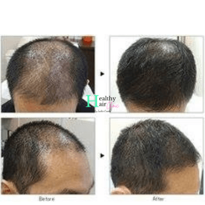 Healthy Hair Clinic - hair transplant in Houston, TX