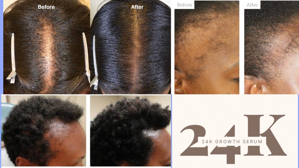 Pomi Hair Vibes - hair transplant in Dallas, TX