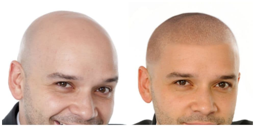 Complete Micropigmentation - hair transplant in Phoenix, AZ