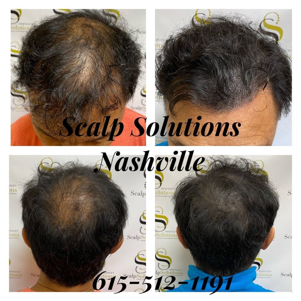 Scalp Solutions Nashville - hair transplant in Brentwood, TN