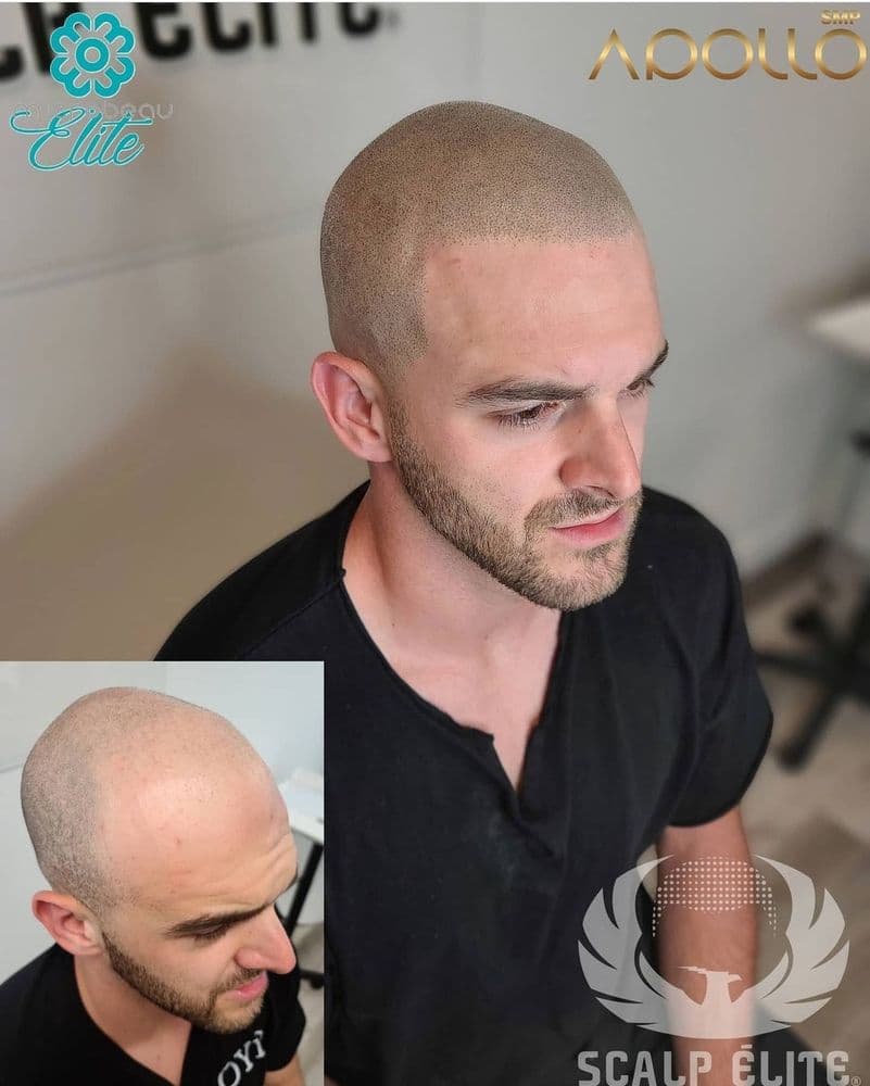 Scalp Elite - hair transplant in Miami Lakes, FL
