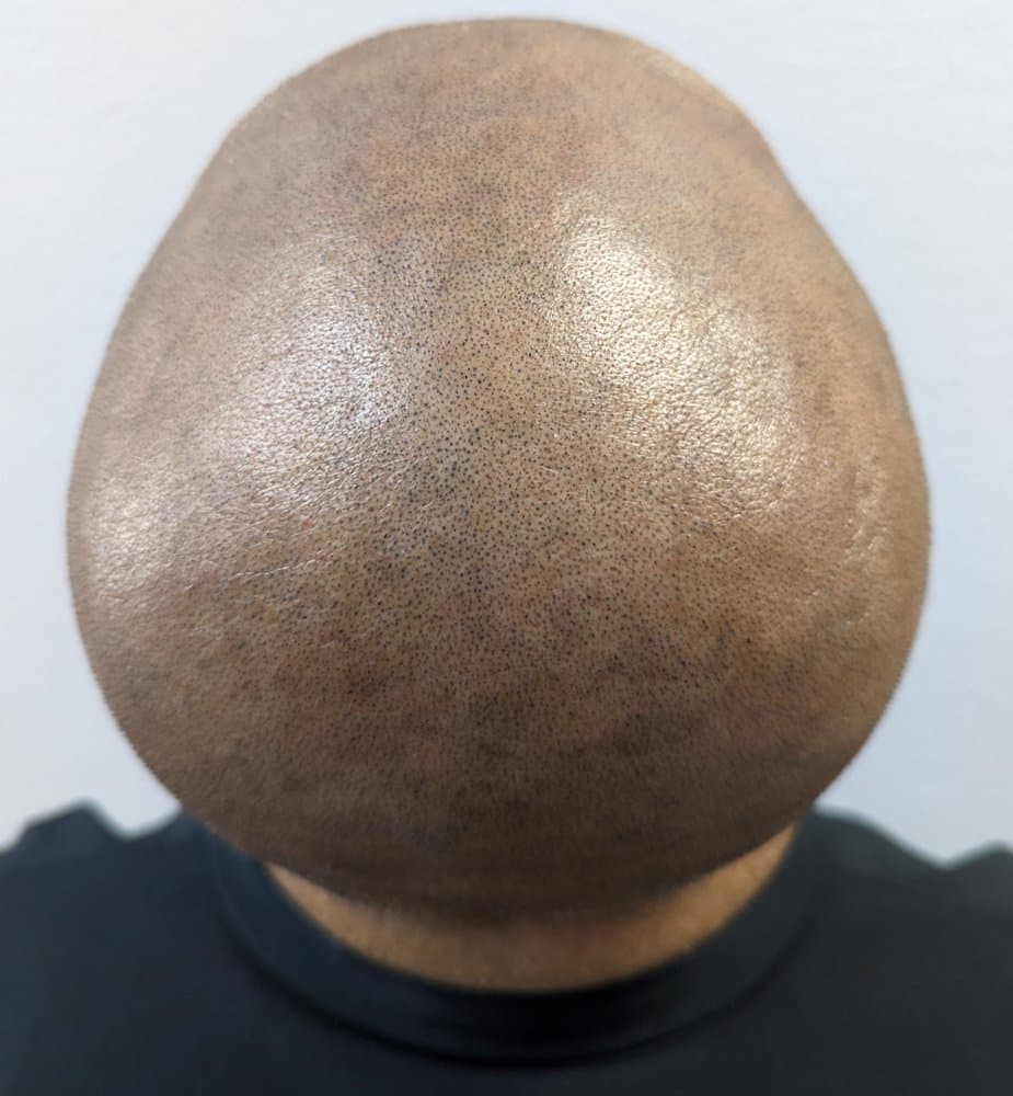 Apex SMP - hair transplant in Spring Valley, NV