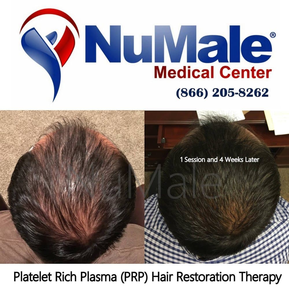 NuMale Medical Center - hair transplant in Charlotte, NC