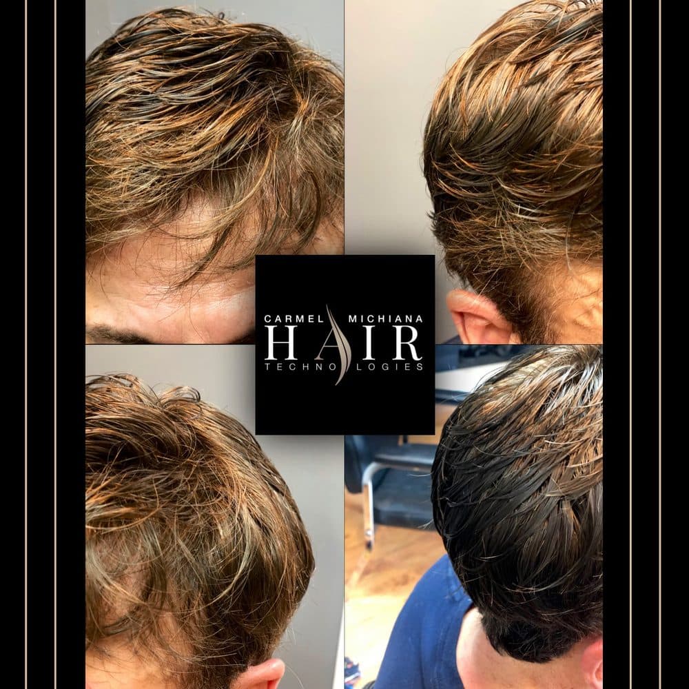 Carmel Hair Technologies - hair transplant in Carmel, IN