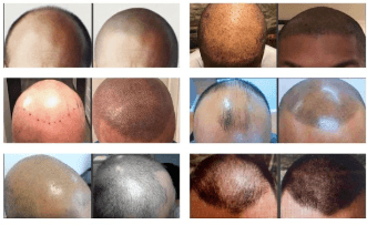 Hair Illusion - hair transplant in Marlow Heights, MD