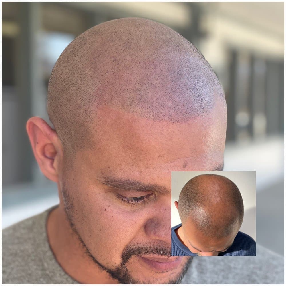 Scalp Therapy - hair transplant in Fountain, CO