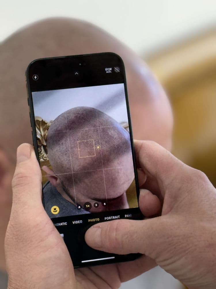 ReScalp SMP | Scalp Micropigmentation - hair transplant in Wethersfield, CT