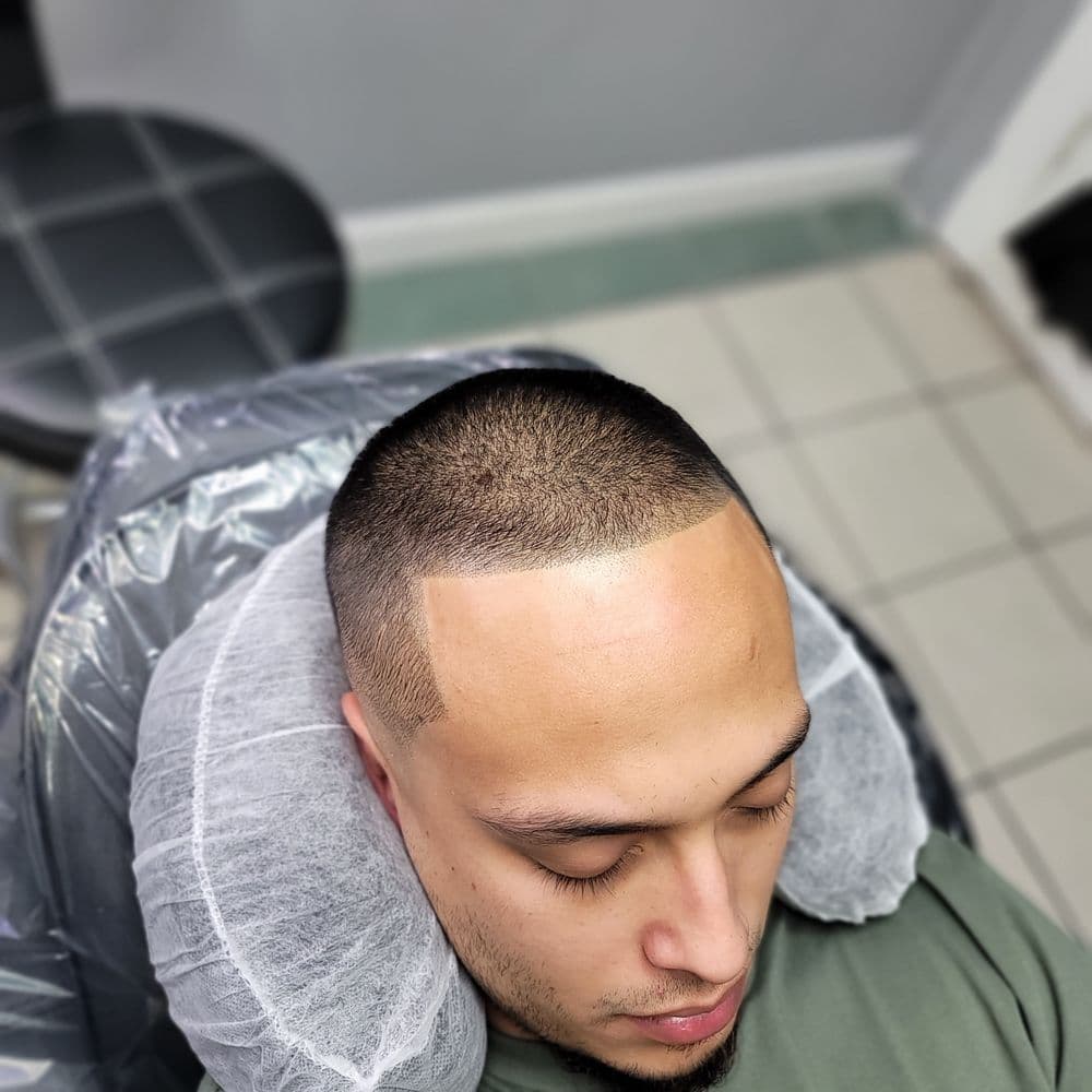 The SMP Company - hair transplant in Fort Worth, TX