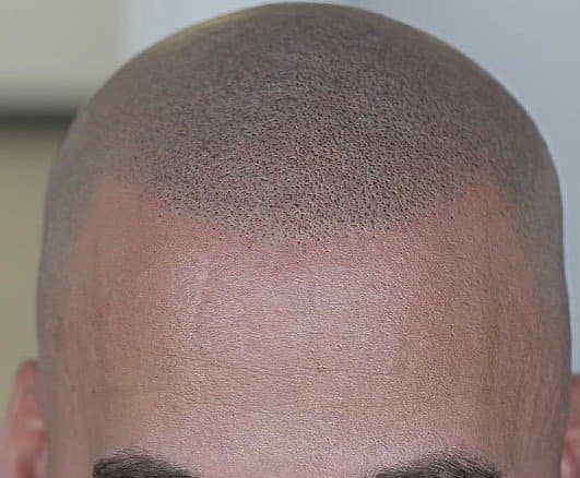 Pro Scalp Micro - hair transplant in Kirkland, WA